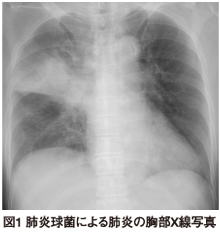 図1 肺炎球菌による肺炎の胸部X線写真