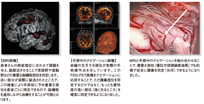 MRI画像,手術中のナビゲーション画像